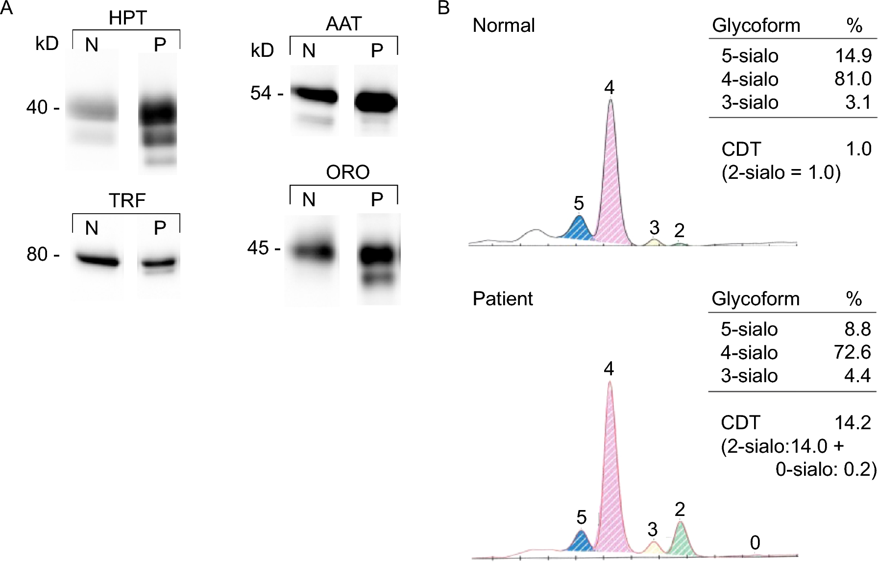 An ALG12-CDG patient with a novel homozygous intronic mutation associated with low ALG12 mRNA