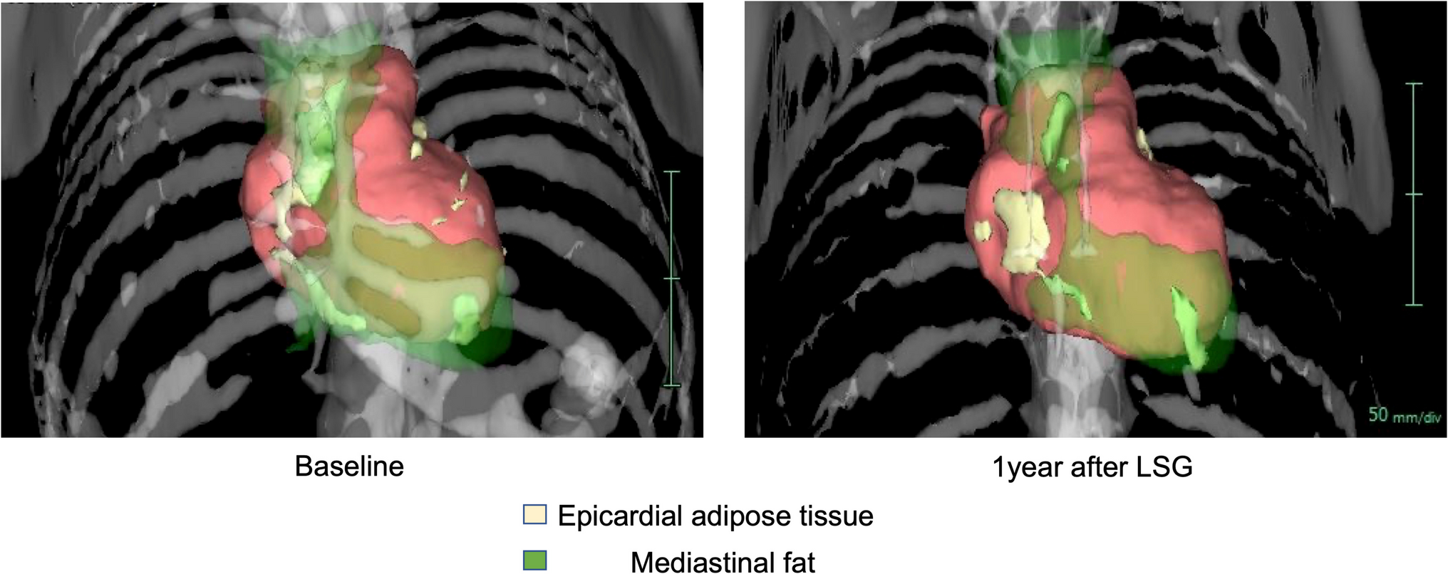 Reductions in Epicardial Adipose Tissue and Mediastinal Fat Are Associated with Improved Cardiac Function