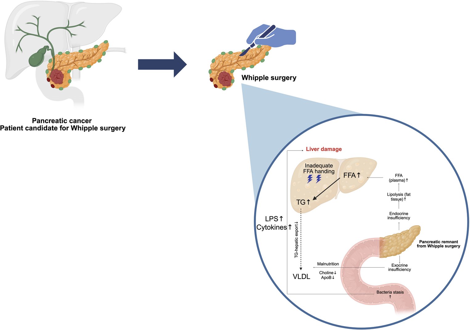 Metabolic Dysfunction–Associated Steatotic Liver Disease after Pancreatoduodenectomy: an Underestimated Metabolic Complication Driven by Unique Pathophysiological Mechanisms