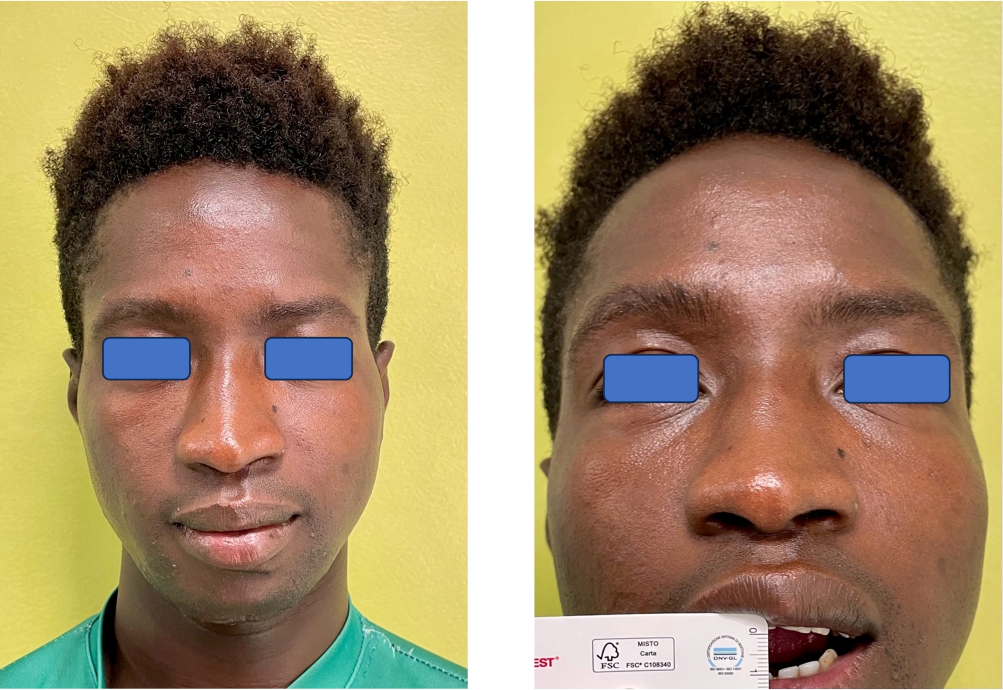 A Pediatric Case of Bilateral Custom Made Prostheses of TMJ and Literature Review