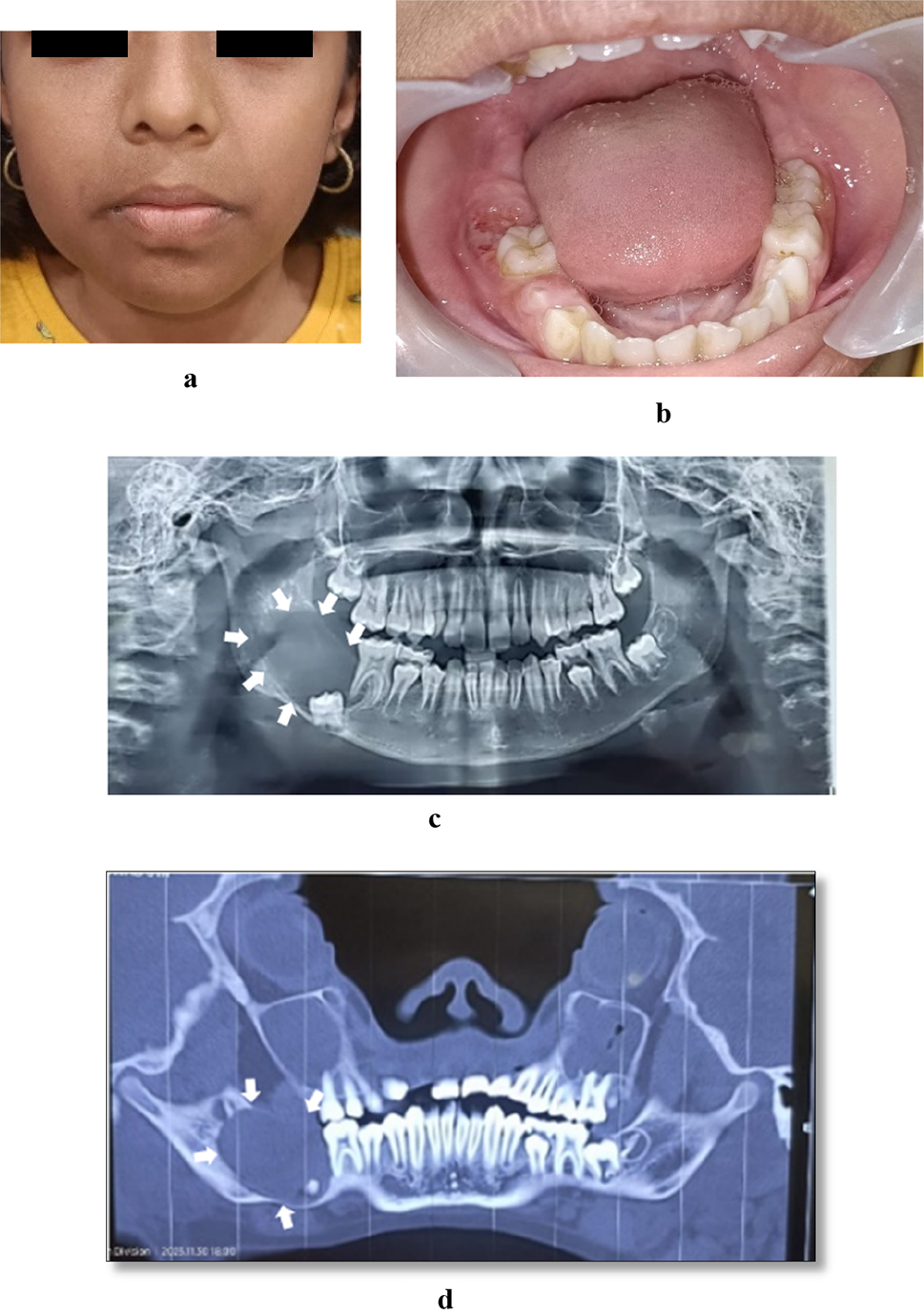 The Virtual Treatment Planning with Patient-Specific Plate in the Management of Mandibular Benign Tumour - A Case Report