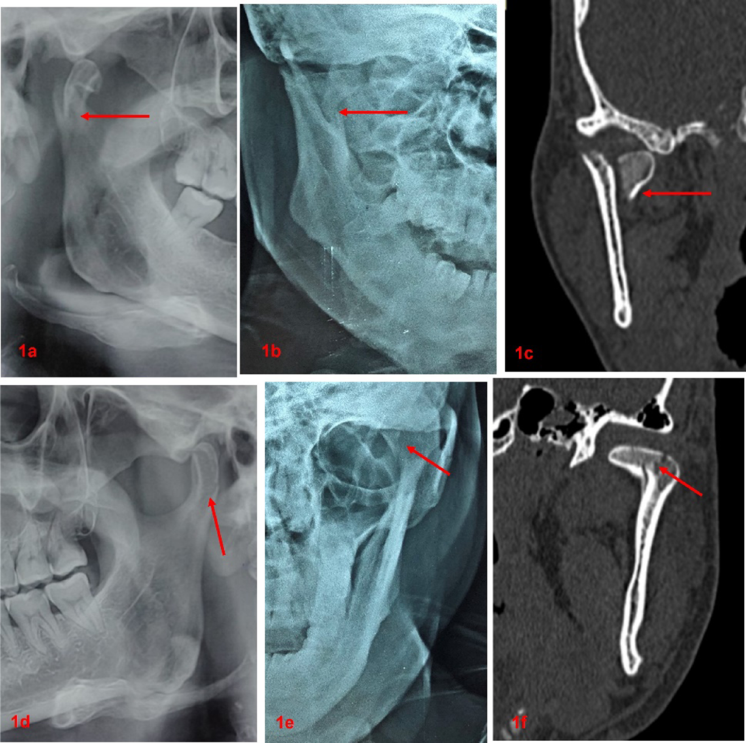 Revisiting conventional radiography in the diagnosis of condylar fractures: a comparison with computed tomography