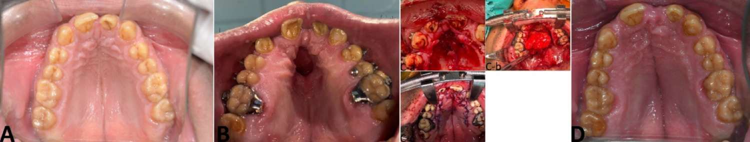 Reconstruction of Oronasal Fistulas with Multiple Techniques: A Case Series Including an Orthodontic Appliance-Induced Defect