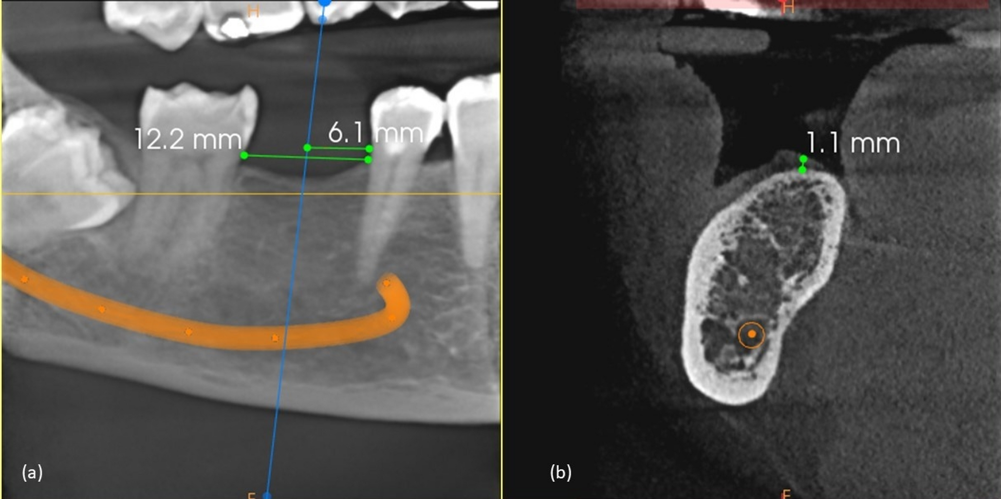 Crestal Soft Tissue Thickness in the Mandibular First Molar Region: A Cross-sectional Retrospective Analysis of Radiographic Data