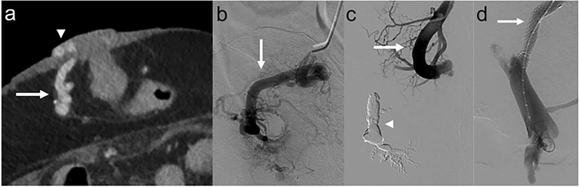 Transvenous Embolization for Stomal Variceal Hemorrhage with Versus Without Portal Decompression