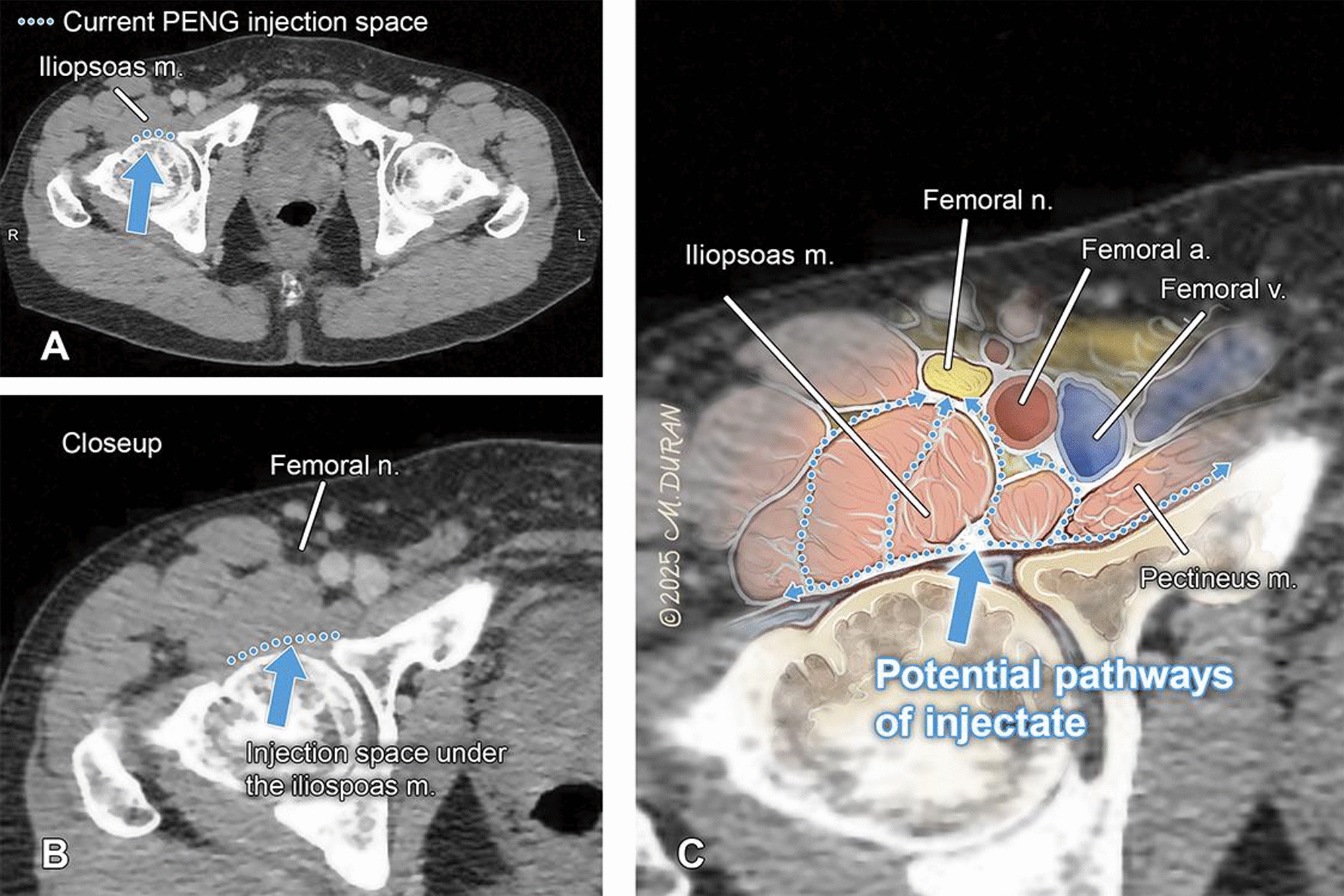 CT-Guided Pericapsular Nerve Group Blocks: An Adaptation to Increase Safety