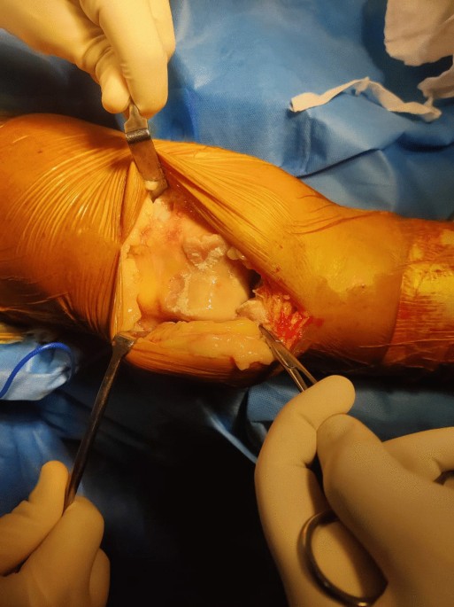 Inflammatory changes in osteoarthritis knees undergoing total knee arthroplasty: a prospective clinical and histopathological study