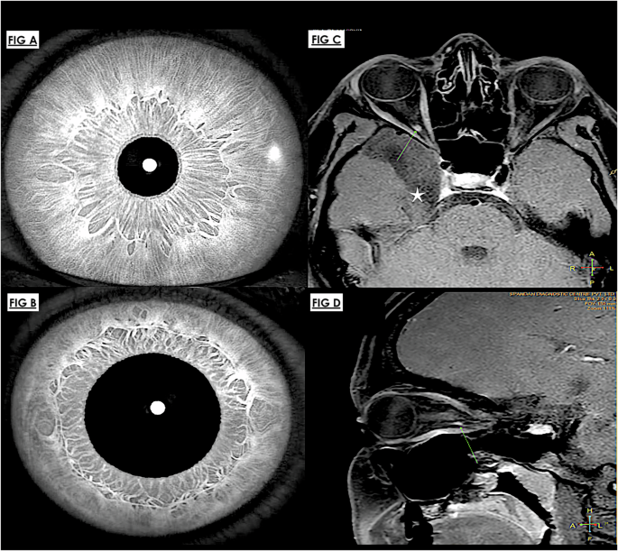 Adie’s tonic pupil: a clinicoradiological insights