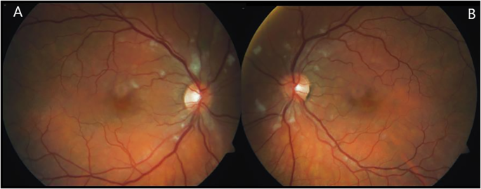 Influenza-associated Purtscher-like retinopathy
