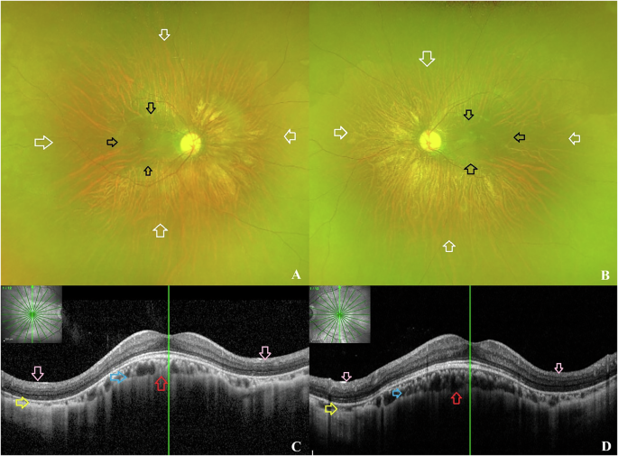Post-equatorial annular staphyloma with preserved macula and dome-shaped configuration