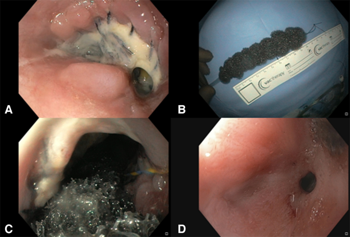 Indigenous endoscopic vacuum-assisted closure therapy for esophageal leaks: A novel technique