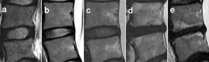 Independent Association Between Lumbar Intervertebral Disc Degeneration and Fatty Degeneration of Paravertebral Muscles