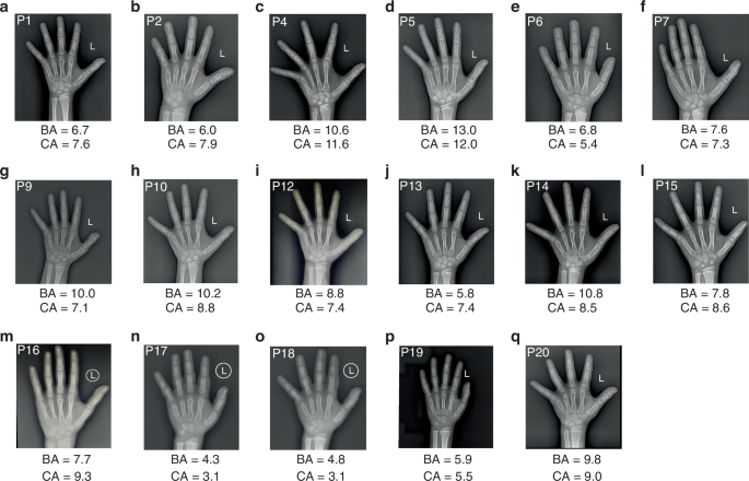 Phenotypic and genotypic diversity in patients with Chinese aggrecan gene-related short stature
