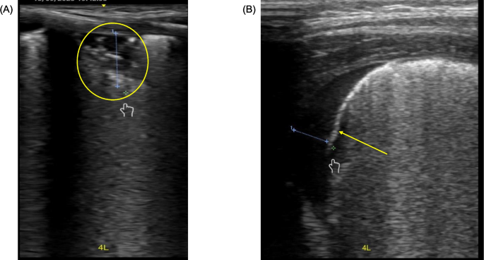 Lung ultrasound findings in neonatal viral pneumonia: case series and literature review