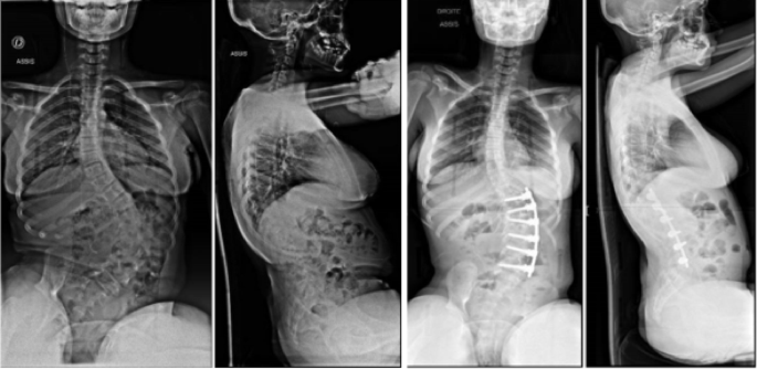 Surgical management of scoliotic deformities related to spina bifida: complication rates, radiographic parameters, and quality of life