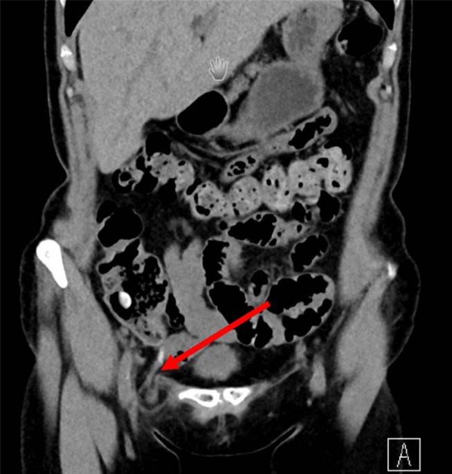 Robotic-assisted inguinal hernia repair with concomitant robotic-assisted appendectomy in a patient with incarcerated de Garengeot hernia—a case report