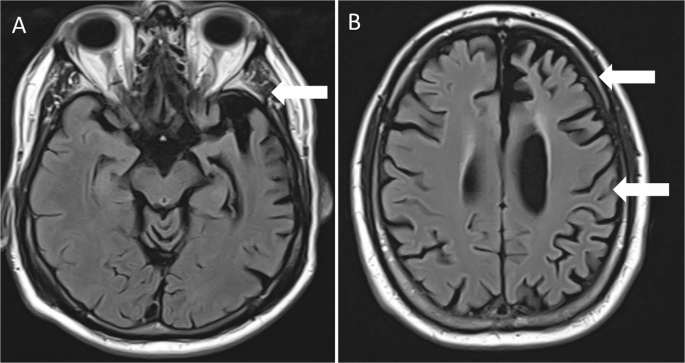 Frontotemporal lobar degeneration in a patient carrying a pathogenic  expansion