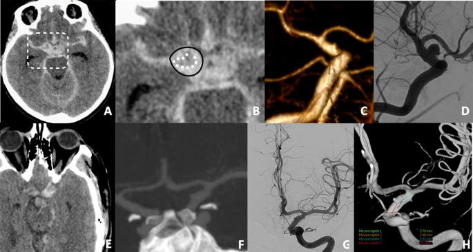 The blister sign on non-contrast CT for detection of blood blister-like aneurysms in acute subarachnoid hemorrhage
