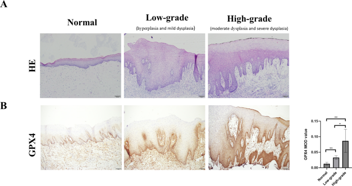 DIRAS2 promotes the progression of oral leukoplakia via suppressing ferroptosis