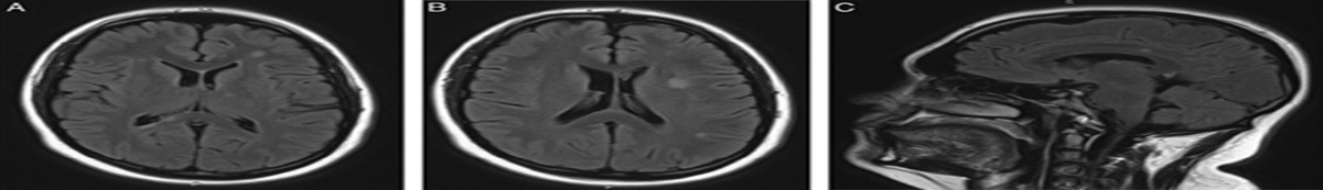 A Case of Combined Central and Peripheral Demyelination Associated With Antineurofascin 155 Antibodies and Paternal History of Multiple Sclerosis
