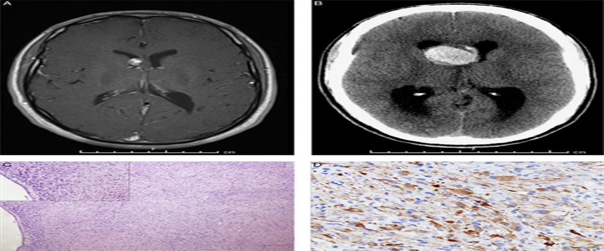 Hemorrhage Into a Subependymal Giant Cell Astrocytoma in an Adult With Tuberous Sclerosis: Case Report