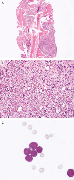 Case 26-2021: A 49-Year-Old Man with Relapsed Acute Myeloid Leukemia