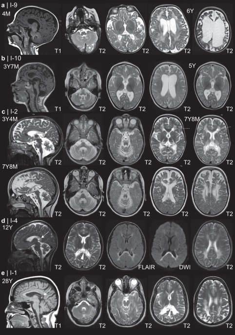 Expanded phenotype of AARS1-related white matter disease