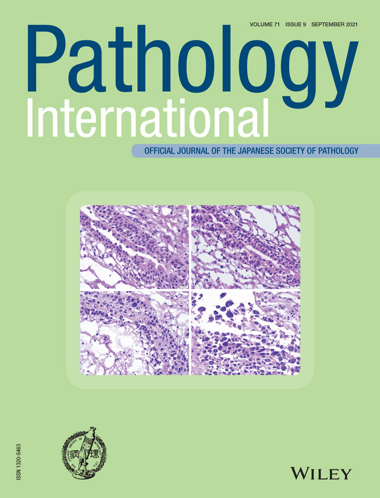 SMARCB1(INI1)‐deficient sinonasal adenocarcinoma: Report of a case previously diagnosed as high‐grade non‐intestinal‐type sinonasal adenocarcinoma