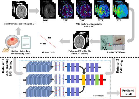 A deep learning‐based model for prediction of hemorrhagic transformation after stroke