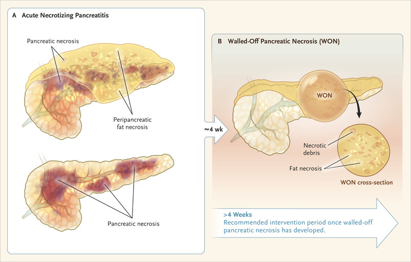 Drainage for Infected Pancreatic Necrosis — Is the Waiting the Hardest Part?