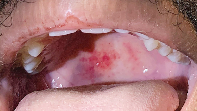 Case 31-2021: A 21-Year-Old Man with Sore Throat, Epistaxis, and Oropharyngeal Petechiae