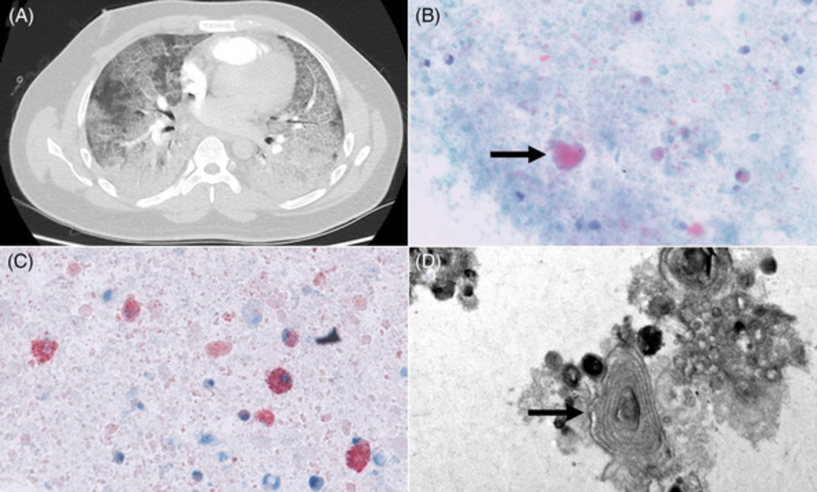 Autoimmune pulmonary alveolar proteinosis with a history of vaping and vitamin E‐positive bronchoalveolar lavage