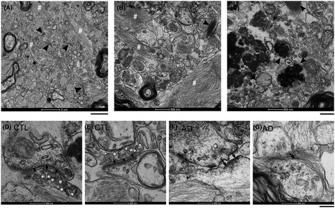 Severe histomorphological alterations in post‐mortem olfactory glomeruli in Alzheimer’s disease