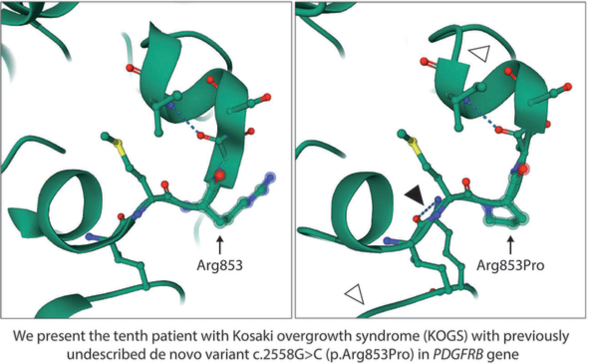 Kosaki overgrowth syndrome due to a novel de novo PDGFRB variant