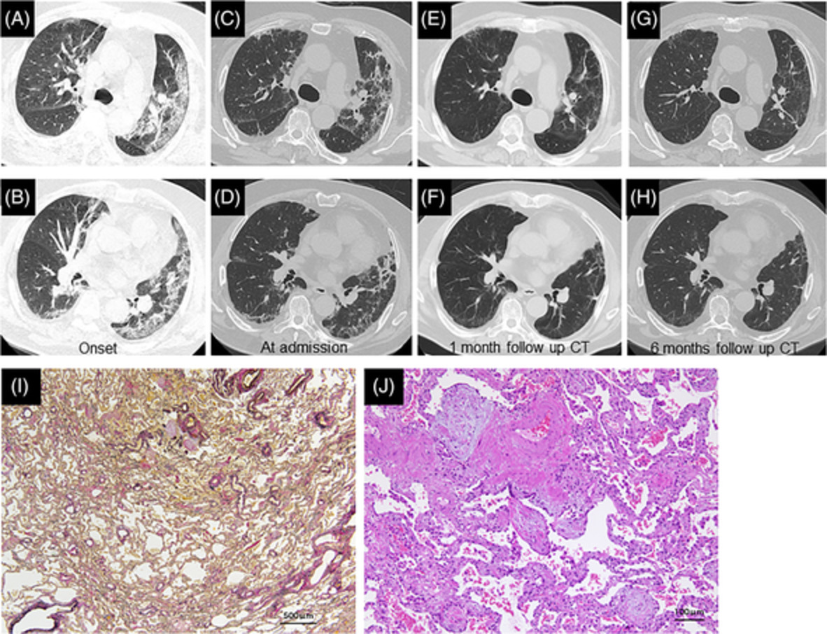 Post‐coronavirus disease 2019 organizing pneumonia confirmed pathologically by video‐assisted thoracoscopic surgery