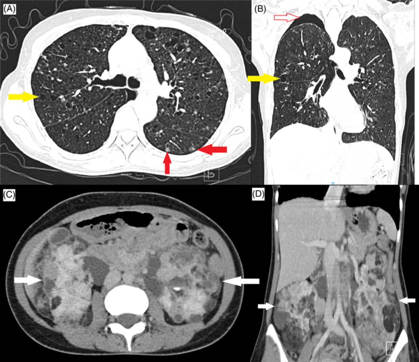 Recurrent pneumothoraces with diffuse small ground‐glass and solid nodules