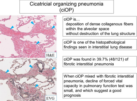 Cicatricial organising pneumonia associated with fibrosing interstitial pneumonia – a clinicopathological study