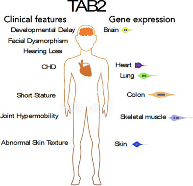 TAB2 variants cause cardiovascular heart disease, connective tissue disorder and developmental delay
