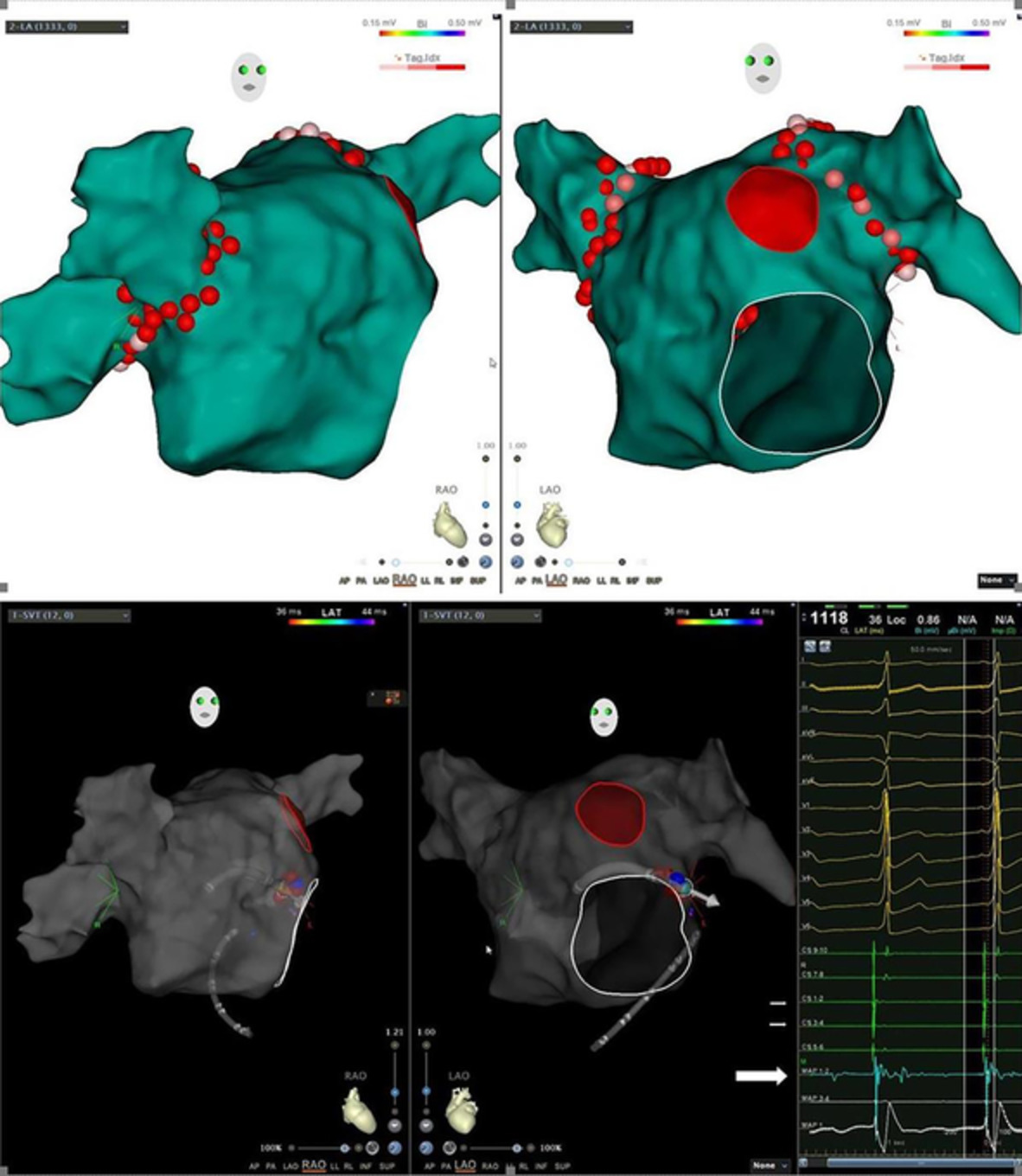 Congenital absence of left atrial appendage combined with type A Wolff‐Parkinson‐White syndrome diagnosed by multimodal imaging