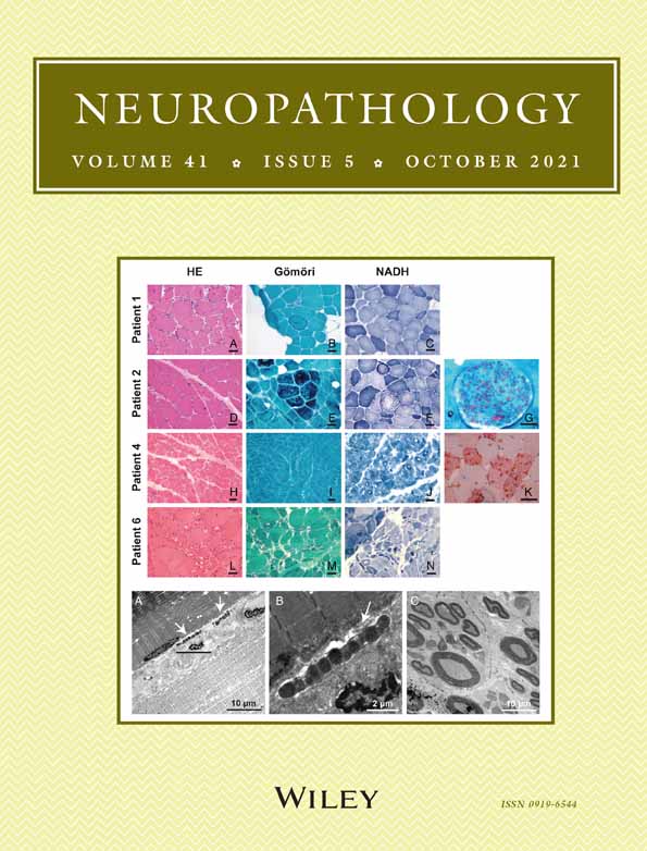 Spinal cord‐predominant neuropathology in an adult‐onset case of POLR3A‐related spastic ataxia