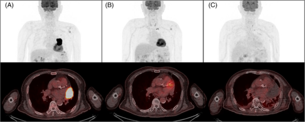 Robust response of pulmonary pleomorphic carcinoma to pembrolizumab and sequential radiotherapy: A case report
