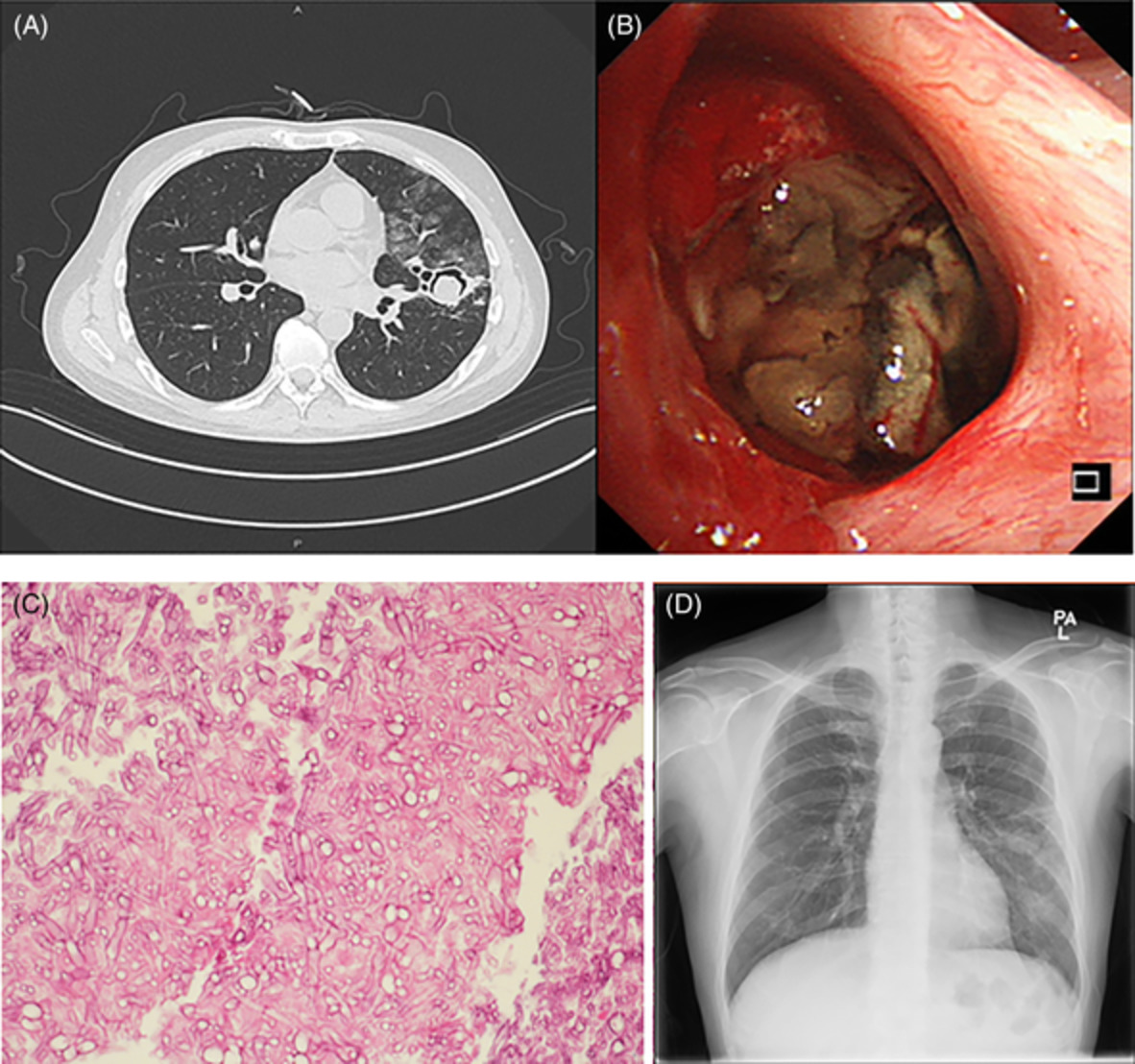 First reported case of late recurrence of pulmonary mucormycosis in a renal transplant recipient with poorly controlled diabetes mellitus