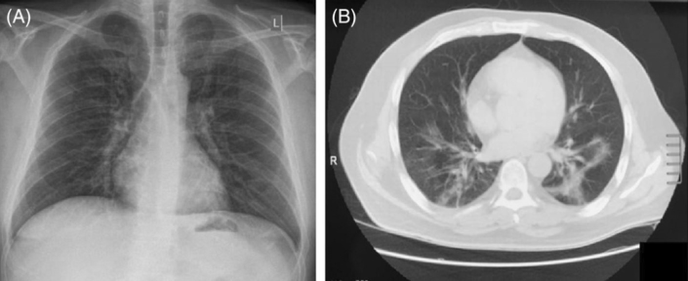 Convalescent plasma therapy in an immunocompromised patient with multiple COVID‐19 flares: a case report