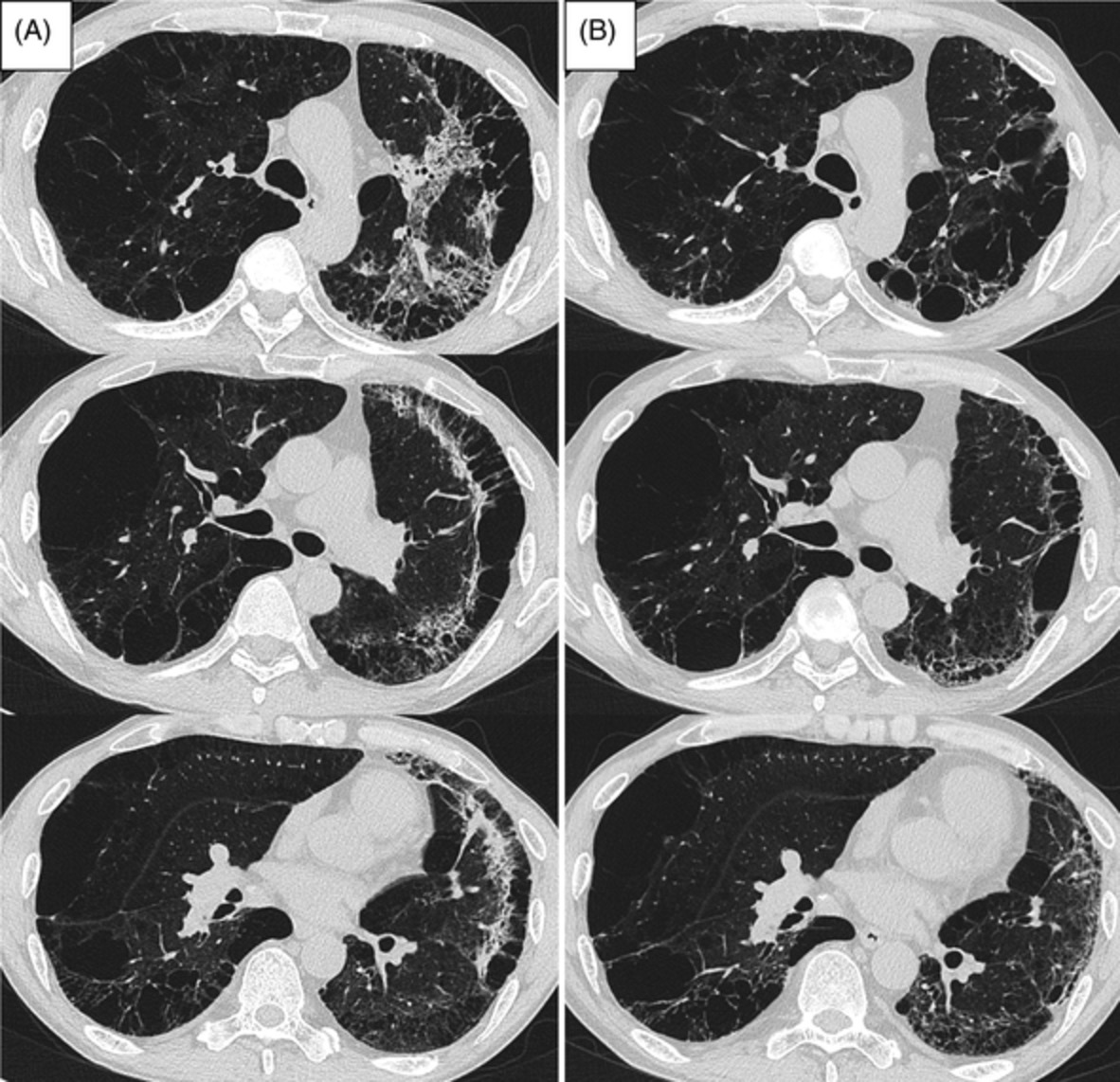 Unusual lung adenocarcinoma spread along with pulmonary emphysema