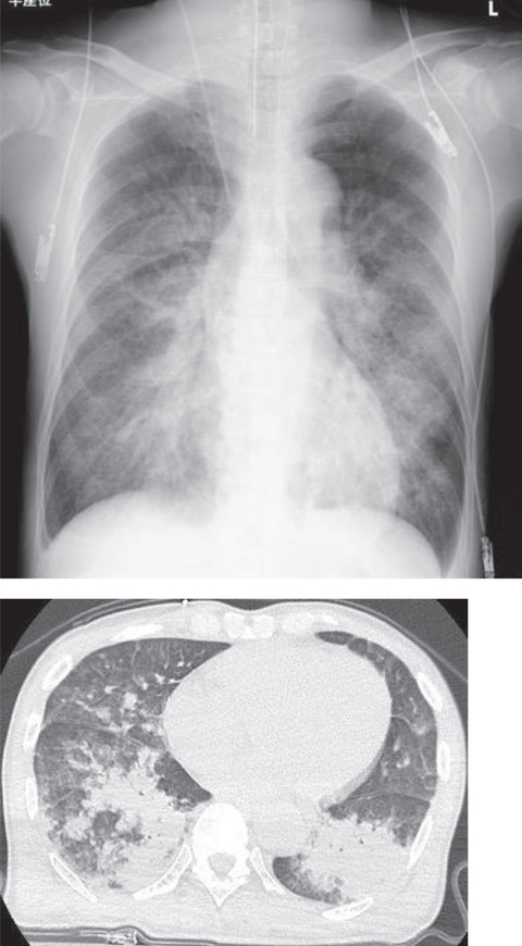 Severe immersion pulmonary edema in a novice elderly scuba diver after heavy alcohol intake
