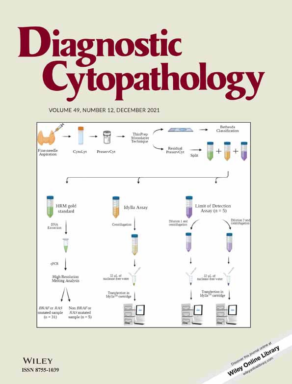 Synchronous uterine and bladder cancers detected in urine and vaginal samples by cytology