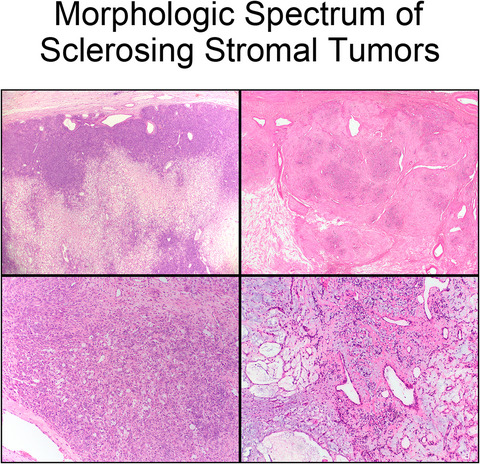 Sclerosing stromal tumour: a clinicopathological study of 100 cases of a distinctive benign ovarian stromal tumour typically occurring in the young