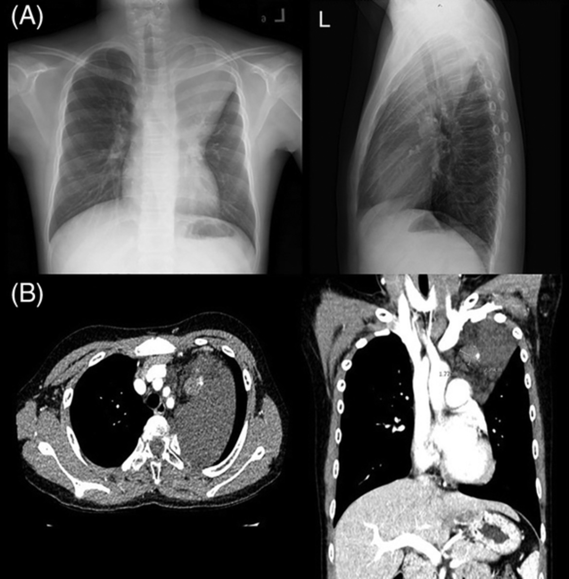 A rare case of mediastinal lymphatic venous malformations in children