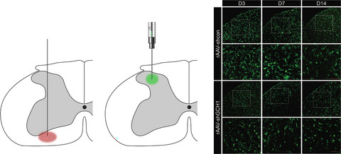 Microglial deactivation by adeno‐associated virus expressing small‐hairpin GCH1 has protective effects against neuropathic pain development in a spinothalamic tract‐lesion model