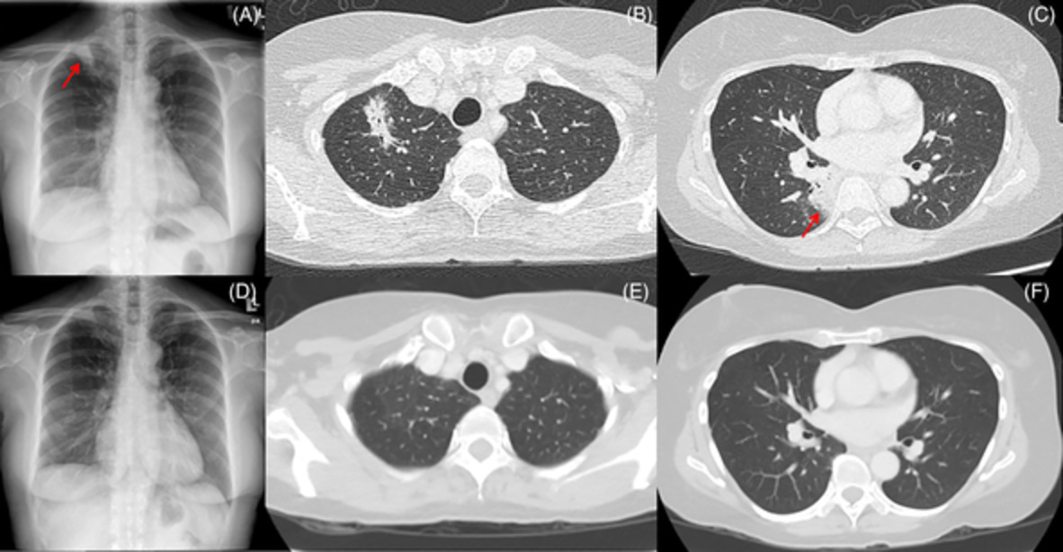 Two cases of cryptogenic organizing pneumonia masquerading as tuberculosis (TB) in a TB endemic area